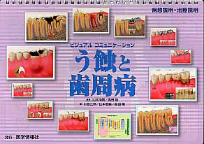 う蝕と歯周病 ビジュアルコミュニケーション