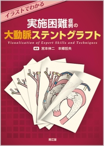 イラストでわかる 実施困難症例の大動脈ステントグラフト
