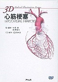 ３Ｄ　Ｍｅｄｉｃａｌ　Ｉｌｌｕｓｔｒａｔｉｏｎ　Ｓｅｒｉｅｓ　心筋梗塞