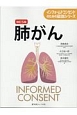 肺がん＜改訂5版＞　インフォームドコンセントのための図説シリーズ